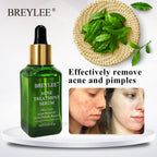 Breylee Acne Serum - Bye to Acne and Breakouts