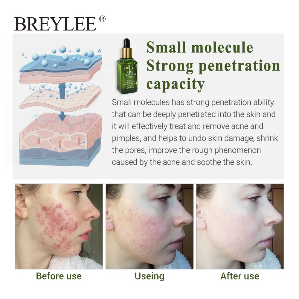 Breylee Acne Serum - Bye to Acne and Breakouts