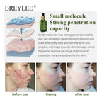 Breylee Acne Serum - Bye to Acne and Breakouts