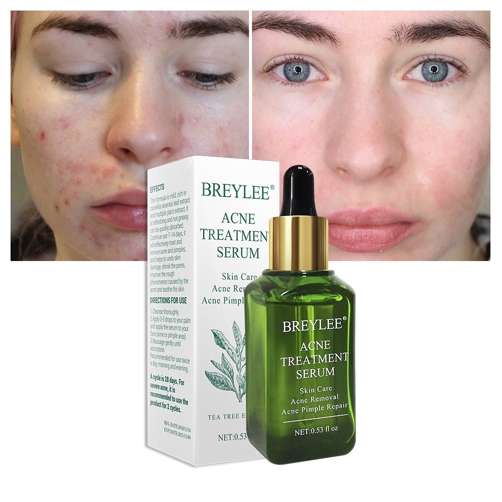 Breylee Acne Serum - Bye to Acne and Breakouts